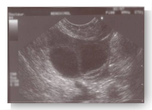 Ultrasound monitoring of follicular growth